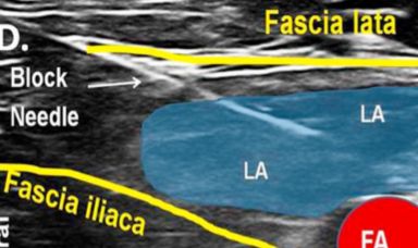 末梢神経ブロック,神経ブロック,エコーガイド,動画,画像