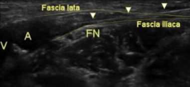 末梢神経ブロック,神経ブロック,エコーガイド,動画,画像